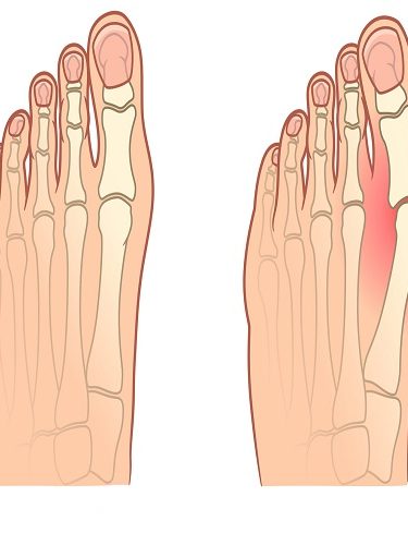 Hallus Valgus Hallus Valgus