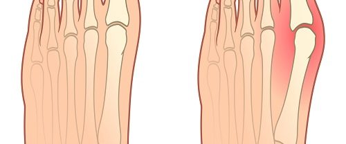 Hallus Valgus