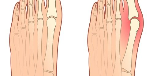 Hallus Valgus Hallus Valgus
