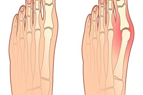 Hallus Valgus