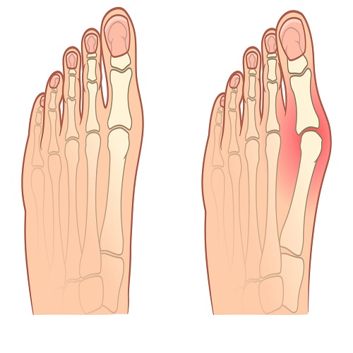 Hallus Valgus Hallus Valgus