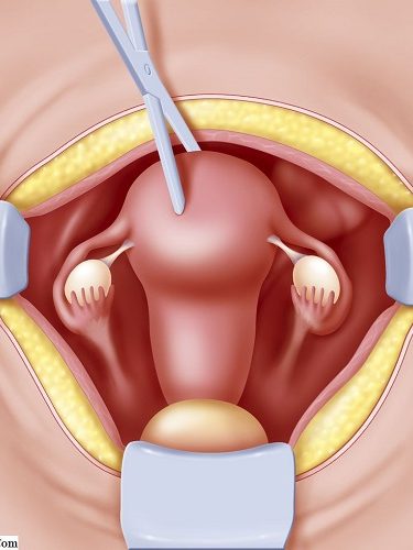Histerektomi Rahim Alınması Histerektomi Rahim Alınması