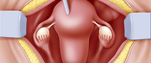 Histerektomi Rahim Alınması