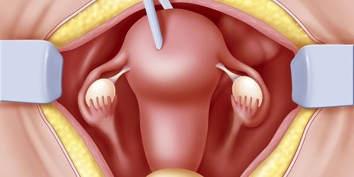 Histerektomi Rahim Alınması