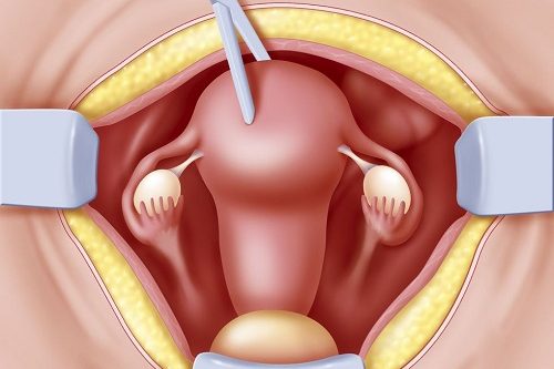 Histerektomi Rahim Alınması