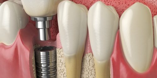 İmplant Tedavisi İmplant Tedavisi