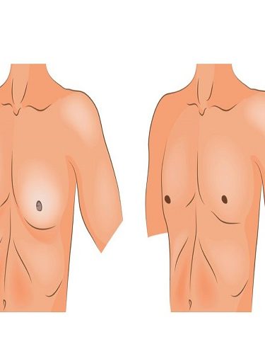 Jinekomasti Jinekomasti