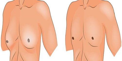 Jinekomasti Jinekomasti