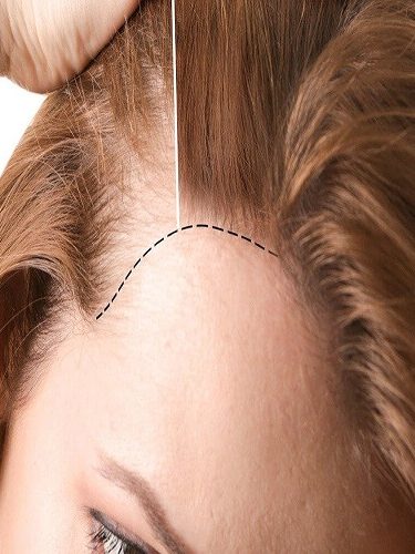 Kadınlarda Saç Ekimi Kadınlarda Saç Ekimi