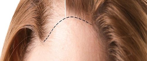 Kadınlarda Saç Ekimi