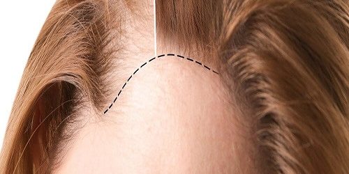 Kadınlarda Saç Ekimi