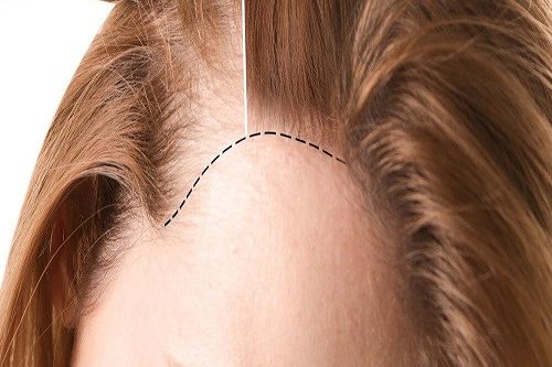 Kadınlarda Saç Ekimi