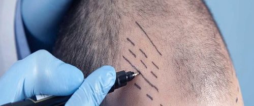 Kalem Tekniği Saç Ekimi