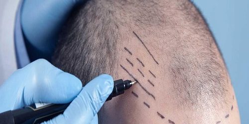 Kalem Tekniği Saç Ekimi