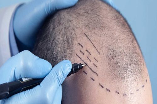 Kalem Tekniği Saç Ekimi