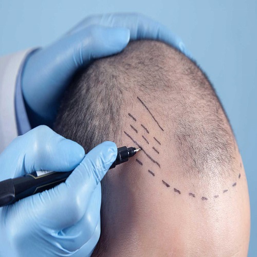 Kalem Tekniği Saç Ekimi