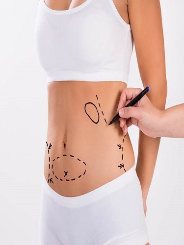 Karın Germe Abdominoplasti Karın Germe Abdominoplasti