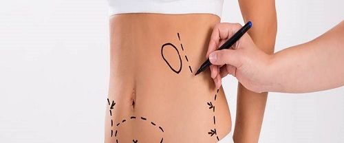 Karın Germe Abdominoplasti