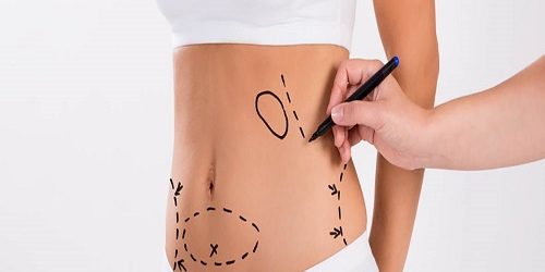 Karın Germe Abdominoplasti