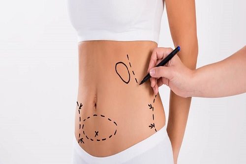 Karın Germe Abdominoplasti