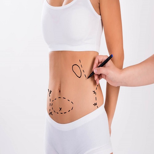 Karın Germe Abdominoplasti Karın Germe Abdominoplasti