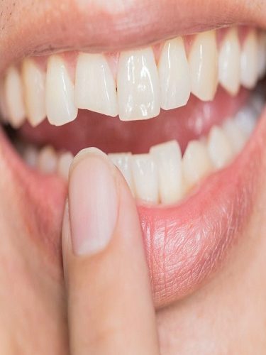 Kısa ve Kırık Dişlerin Tedavisi Kısa ve Kırık Dişlerin Tedavisi