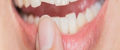 Kısa ve Kırık Dişlerin Tedavisi