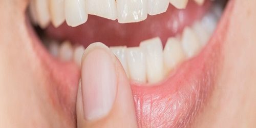 Kısa ve Kırık Dişlerin Tedavisi