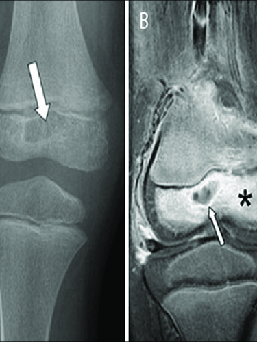 Kronik Osteomiyelit Kronik Osteomiyelit