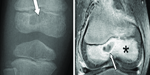 Kronik Osteomiyelit Kronik Osteomiyelit
