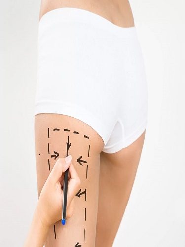 Lazer Lipoliz Plus Lazer Lipoliz Plus