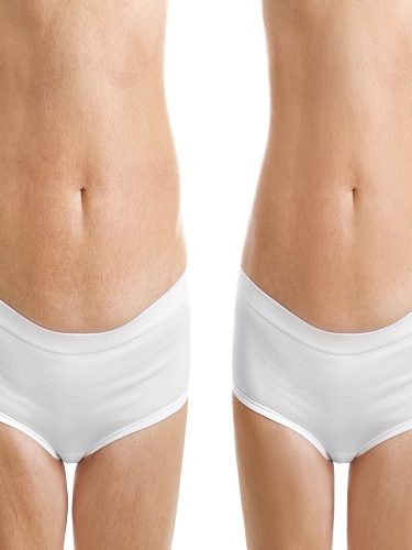 Lazer Liposuction Lazer Liposuction