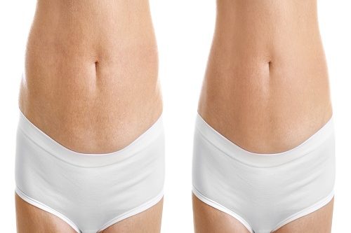 Lazer Liposuction