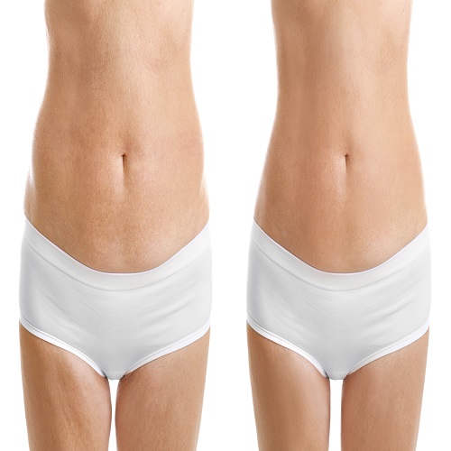 Lazer Liposuction Lazer Liposuction