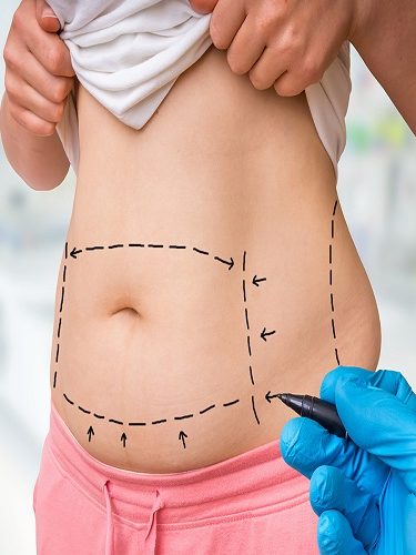 Liposuction Liposuction