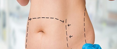Liposuction