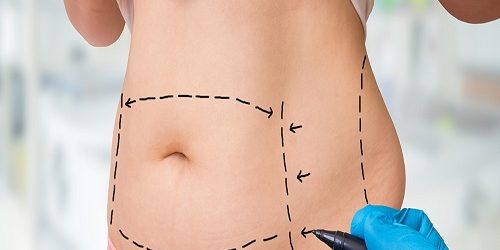 Liposuction Liposuction