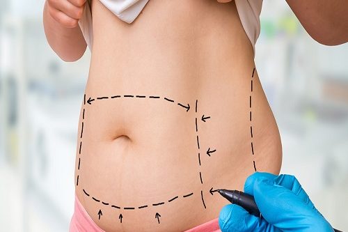 Liposuction
