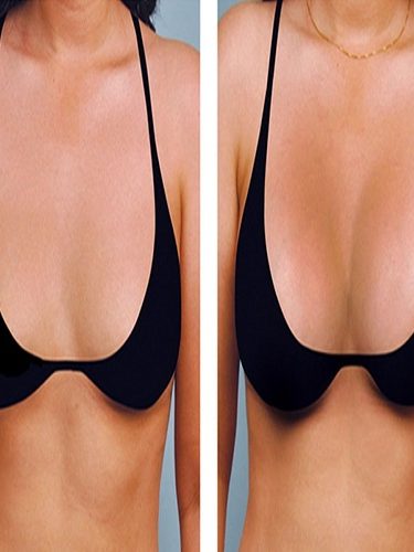 Meme Büyütme Meme Büyütme