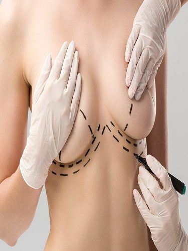 Meme Dikleştirme Meme Dikleştirme