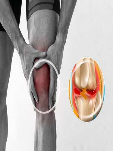 Kelebek Tekniği ile Menisküs Onarımı Kelebek Tekniği ile Menisküs Onarımı