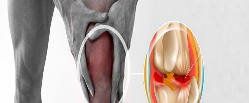 Kelebek Tekniği ile Menisküs Onarımı