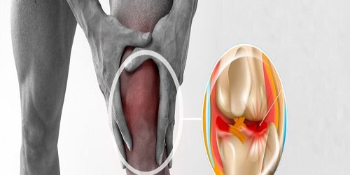 Kelebek Tekniği ile Menisküs Onarımı Kelebek Tekniği ile Menisküs Onarımı