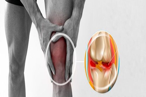 Kelebek Tekniği ile Menisküs Onarımı