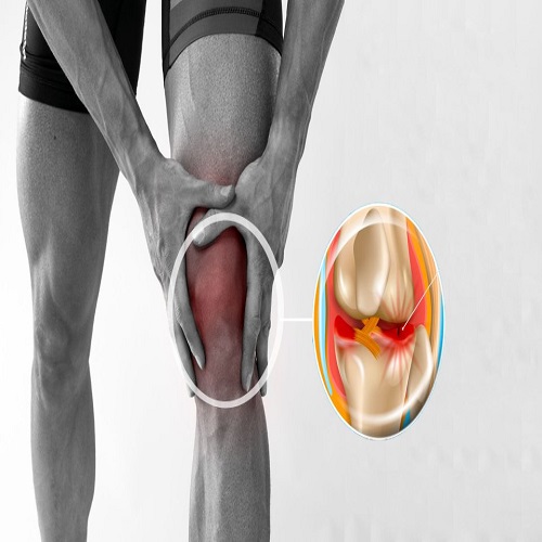 Kelebek Tekniği ile Menisküs Onarımı