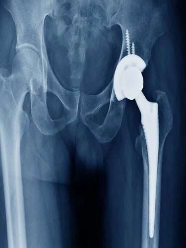 Total Kalça Artroplastisi Total Kalça Artroplastisi