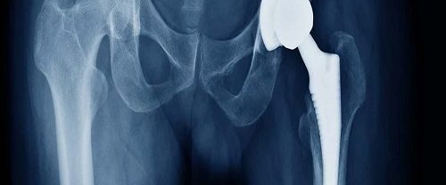 Total Kalça Artroplastisi