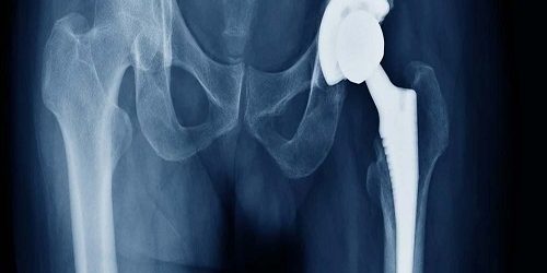 Total Kalça Artroplastisi Total Kalça Artroplastisi