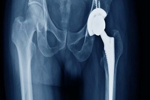 Total Kalça Artroplastisi