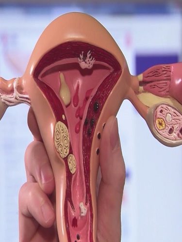 Myomektomi Myomektomi